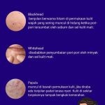 Jenis2 Jerawat Dan Cara Mengatasinya 21cd43ab8